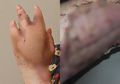 'Hanya' Karena Dicakar Kucing, Wanita 45 Tahun Kehilangan Jari Tangannya Hingga Hampir Meninggal