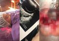 Sering Makan Junk Food, Dokter Temukan 2 Kista Besar di Ovarium Remaja Wanita Ini
