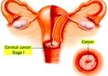 Kanker Serviks Pembunuh no 2 Bagi Wanita Indonesia, Mereka yang Kekurangan Vitamin E Salah Satu Paling Berisiko