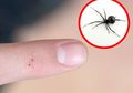 Pernah Digigit Laba-laba, Kutu, Hingga Lebah? Jangan Panik, Begini Cara Mengobatinya