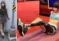 Kisah Gadis Berkaki Satu, Wakili Kompetisi Tari Internasional dan Pede Kenakan Rok Pendek, Buktikan Orang Cacat Bisa Hidup Normal