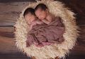 Monochorionic Twins Kembar Identik yang Berbagi Plasenta di Dalam Rahim
