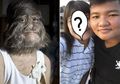 Masih Ingat Gadis Berwajah Serigala yang Alami Sindrom Langka Werewolf? Begini Penampakannya yang Cantik Setelah Dicukur Habis