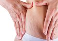 Banyak yang Keliru, Kenali Perbedaan Selulit dan Stretch Mark Menurut Pakar