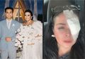 Baru 3 bulan Menikah dengan Ajun Perwira, Jennifer Jill Perlihatkan Wajah dengan Balutan Perban, Singgung KDRT