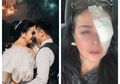 Umur Pernikahan Masih Seumur Jagung, Istri Ajun Pawira Ini Muncul dengan Mata Sebelah Diperban, Apakah Ada KDRT?