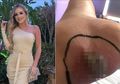 Bukan Sekedar Lecet, Model Ini Relakan Kaki Cantiknya Diamputasi Akibat Lepuhan di Pergelangan Kaki