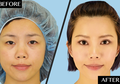 Inilah 6 Operasi Plastik Paling Sering Dilakukan di Korea Selatan, Benarkah Bikin Jadi Lebih Cantik?