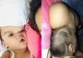 Kepala Bayi 11 Bulan Ini Membengkak Seperti Balon Hingga Kesulitan Melihat, Keluarga Mati-matian Cari Ahli Bedah