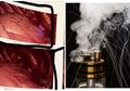 Mengerikan, Beginilah Penampakan Paru-paru Pemuda yang Setahun Pakai Vape Ini, Muncul Gelembung-gelembung Hitam