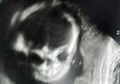 Tampak Mengerikan Sampai Ibunya Ketakutan di Ultrasound, Beginilah Kondisi Bayi Ini Setelah Dilahirkan