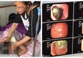 Ngeri! Dikira Sakit Perut Biasa, Setelah Diperiksa Ternyata Perut Gadis Kecil Ini Berisi Gumpalan Rambut