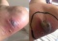 Jangan Sepelekan Lecet Kaki Karena Sepatu! Wanita Ini Nyaris Tewas Setelah Lukanya Mengalami Sepsis