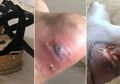 Wanita Ini Nyaris Meninggal Akibat Infeksi yang Disebabkan Sepatu dengan Model Seperti Ini