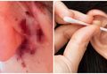 Mengerikan, Gara-gara Sering Pakai Cotton Bud, Wanita Ini Alami Infeksi Otak hingga Gerogoti Tengkorak Belakang Telinga