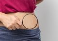 Catat nih! 4 Cara Mencegah Stretch Mark, Kulit Mulus Bukan Cuma Mimpi