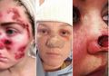 Kisah Wanita-wanita yang Mengejar Kulit Keemasan Eksotis dan Melakukan Tanning dengan Sunbed, Akhirnya Justru Memprihatinkan dengan Bekas Lubang dan Darah