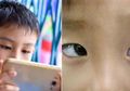 Mata Bocah 9 Tahun Ini Juling Setelah Main Game Ponsel Selama 10 Jam Tiap Hari