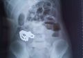 Mengeluh Sakit Perut, Dokter Temukan 64 Manik-manik Magnetik dalam Perut Bocah Ini, Kok Bisa?