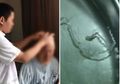 Menyangka Sakit Keras, Pria Ini Langsung Sembuh Setelah Benda Ini Diambil dari Tengkoraknya