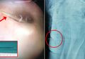 Tak Bisa Buang Air Kecil Selama 3 Hari, Rupanya Ada Jarum 9cm Menyumpat Organ Vital Bocah Ini, Kok Bisa?