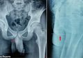 Ngilu! Tak Bisa Kencing Selama 3 Hari, Rupanya Bocah ini Masukkan Jarum ke Alat Vitalnya, Alasannya Bikin Geleng-geleng Kepala!