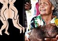 Viral Bayi Dempet Kepala Ditemukan di Cianjur, Kasihan Mereka Mengalami Penyakit Berat Lainnya
