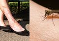 Akibat Digigit Nyamuk, Kaki Wanita Ini Membengkak hingga Detak Jantungnya Berhenti Tiba-tiba, Ternyata Ini yang Terjadi