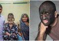 Gara-Gara Minum Obat, 16 Bocah Alami Werewolf Syndrome dan Wajahnya Dipenuhi Rambut