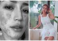 Wajah Mulus Jessica Iskandar Dipenuhi Bercak Merah, Obat Antibiotik Selama Proses Anestesi Bisa Jadi Penyebabnya