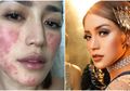 Berbahaya! Inilah Penyebab, Pencegahan, dan Pengobatan Alergi Anastesi yang Dialami Jessica Iskandar