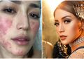 Prihatin! Wajah Mulus Jessica Iskandar Tiba-Tiba Dipenuhi Bercak Merah Sampai Tak Bisa Kerja, Ternyata Akibat Iritasi