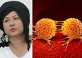 Sebelum Meninggal, Ria Irawan Idap Kanker Kelenjar Getah Bening: Benjolan di Leher atau di Belakang Telinga Bisa Jadi Penyebabnya