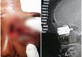 Masak Kacang dengan Panci Presto, Seorang Wanita Jadi Buta, saat Peluit Presto Berubah Bak Peluru