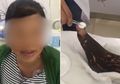 Digigit Ular saat di Toilet, Wanita Ini Malah Berusaha Sendiri Menghilangkan Racun Ular dengan Cara yang Nyeleneh