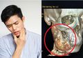 Selama Satu Tahun Alami Sakit Gigi dan Dibiarkan, Rahang Remaja Ini 'Hilang' Digerogoti Tumor