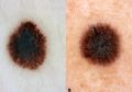 Kanker Kulit Melanoma dan Non-Melanoma Apa Bedanya? Ini Penjelasan Ahli
