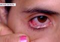 Aneh, Seorang Wanita Keluarkan Air Mata Kristal hingga 50 Butir Sehari, Dokter pun Sulit Mendiagnosis Kelainan yang Sebenarnya