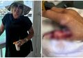 Niat Percantik Kuku di Salon, Perempuan Ini Nyaris Kehilangan Jari Karena Bakteri Pemakan Daging Bersarang di Tangannya