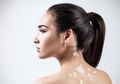 Mengenal Si Kulit Belang Vitiligo, Penyebab dan Cara Mengatasi
