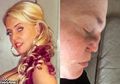 Hidung Wanita Ini Perlahan-lahan ‘Meleleh’ Setelah Dia Mengalami Kondisi Ini Ketika Epilepsinya Kambuh