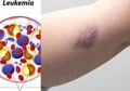 Sering Kita Abaikan, Ini 5 Gejala Leukemia, Salah Satunya Memar