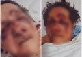 Seorang Anak Tuduh Staf Panti Jompo Aniaya Ibunya hingga Babak Belur dan Hidungnya Patah, Begini Kronologisnya