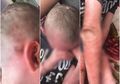 Kulitnya Berjatuhan dan Kesakitan Tiap Bergerak hingga Dokter Menyerah, Bocah 9 Tahun Ini Putus Asa Bilang ke Ibunya Lebih Baik Mati