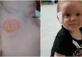 Bayi Tujuh Bulan Alami Luka Bakar Mengerikan Ketika Bangun Tidur, Penyebabnya Benda Lembut yang Justru Biasa Orang Tua Berikan, Peringatan Buat Para Orangtua!