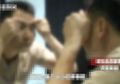 Sembarangan Pencet Jerawat Kecil, Pria Ini Alami Hal Mengerikan Jerawatnya Membesar dan Berubah Menjadi Penyakit Mematikan