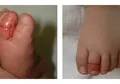 Peringatan Buat Orangtua! Bayi Ini Hampir Kehilangan Jari Kakinya Hanya Gara-gara Ini