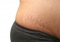 Mengalami Stretch Mark Setelah Melahirkan? Coba Gunakan Bahan Alami Ini Untuk Mengatasinya!