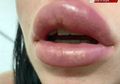 Setelah Suntik Filler Bibir di Klinik, Bibir Wanita Ini Pecah hingga Hampir Buta, Waspadai Penyebabnya
