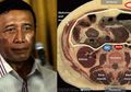 Breaking News Wiranto: 2 Luka Tusuk Pada Tubuhnya Mencapai Lapisan Peritoneum Berisiko Picu Peritonitis